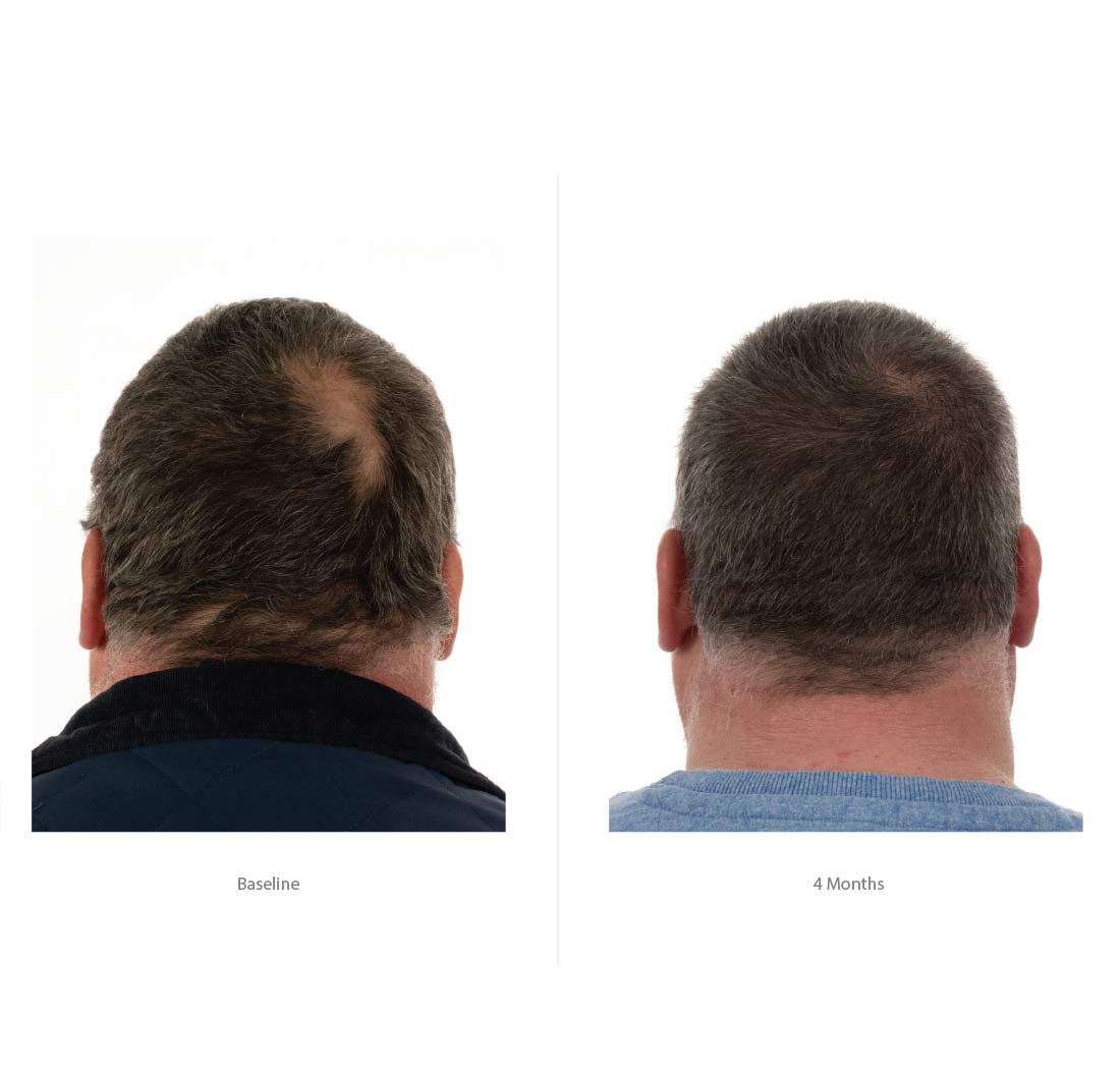 FOLIGAIN® Triple Action Hair Care System For Men 3 Piece Trial Set