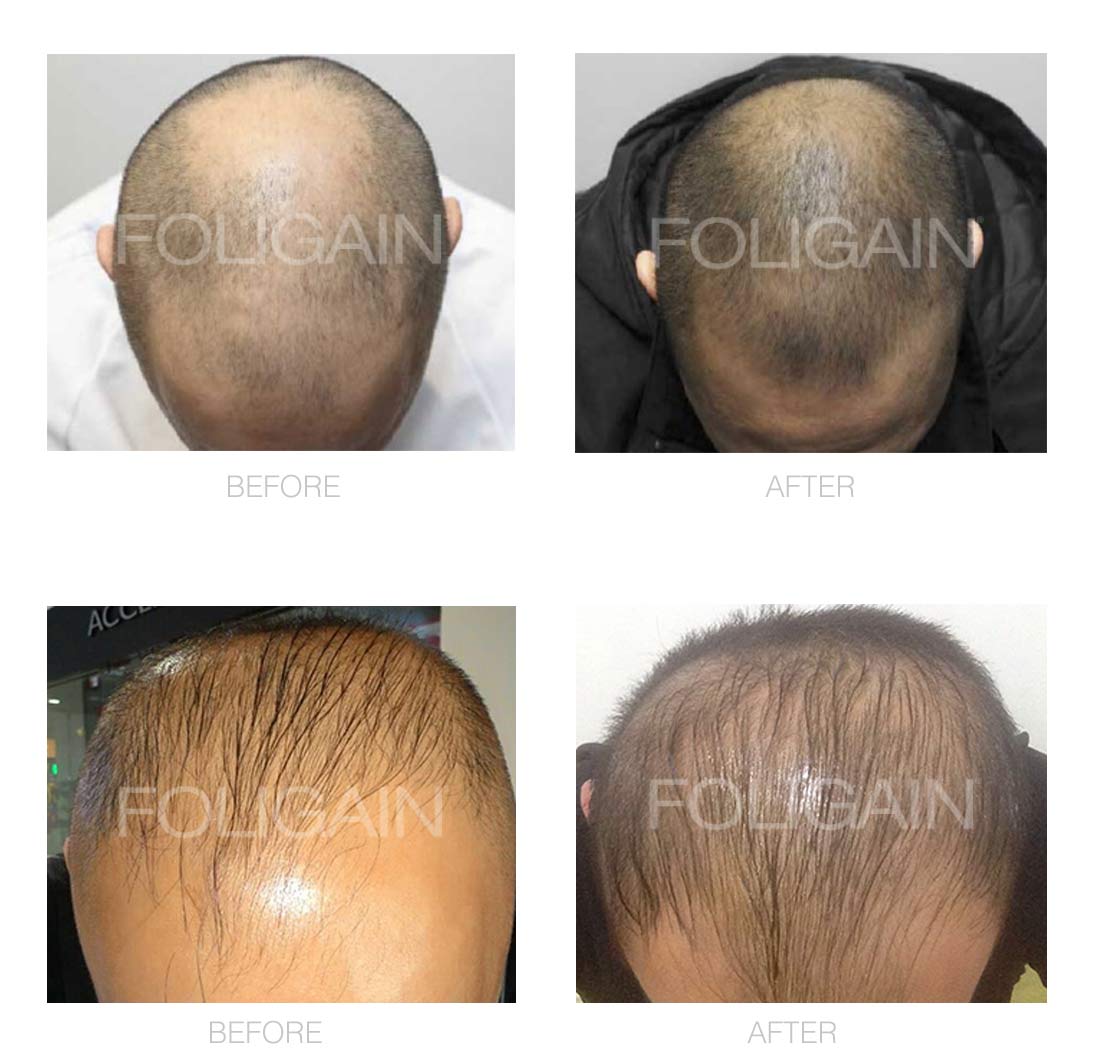 FOLIGAIN® Minoxidil 5% Hair Regrowth Treatment For Men 3 Month Supply